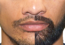 Facial Hair Transplant Procedure