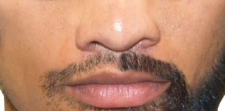 Facial Hair Transplant Procedure