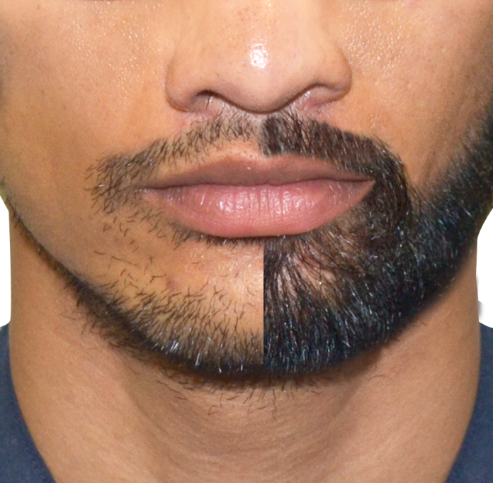 Facial Hair Transplant Procedure