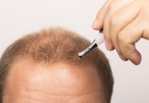 The 4 Best Treatments Available for Receding Hairlines: What You Need to Know