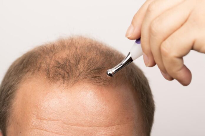 Receding Hairlines