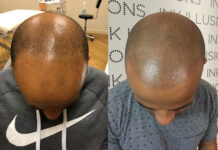 Scalp Micropigmentation: 10 Facts You Must Know