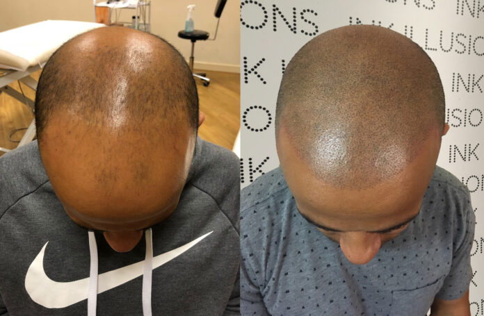 Scalp Micropigmentation
