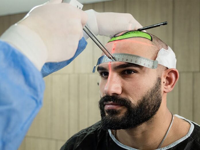 Transform Your Look with Turkey’s Expert Hair Transplant Surgeons