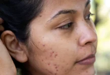 Understanding Acne Scars and How to Effectively Treat Them