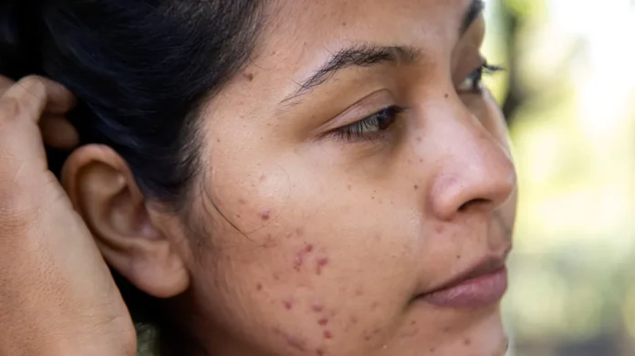 Understanding Acne Scars and How to Effectively Treat Them