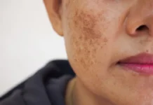 Hyperpigmentation Treatment Singapore: Are they Even Necessary?