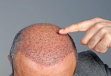 Understanding The Surge In Hair Transplants For Men