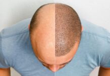 Can You Get a Hair Transplant with Thin Hair?