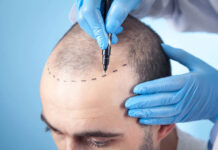 How to Find a Safe Hair Transplant in Turkey and Keep Your Future Haircuts Looking Good