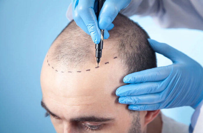 Hair Transplant guide